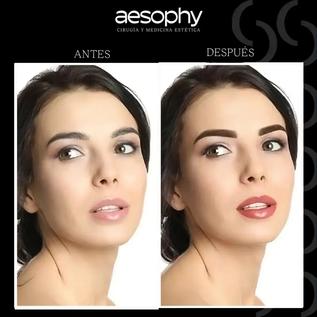 antes y después perfilado de labios Clínica Aesophy