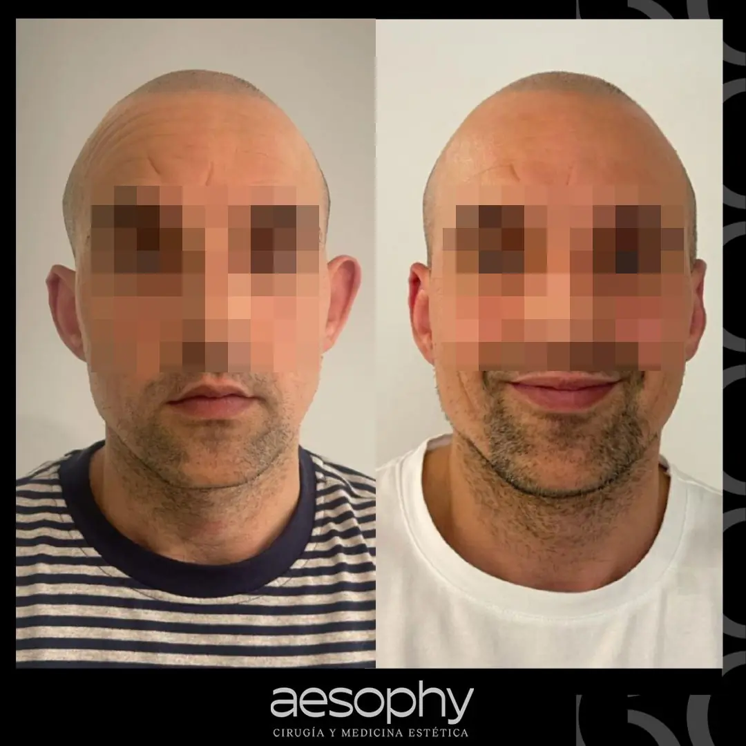 Otoplastia Málaga