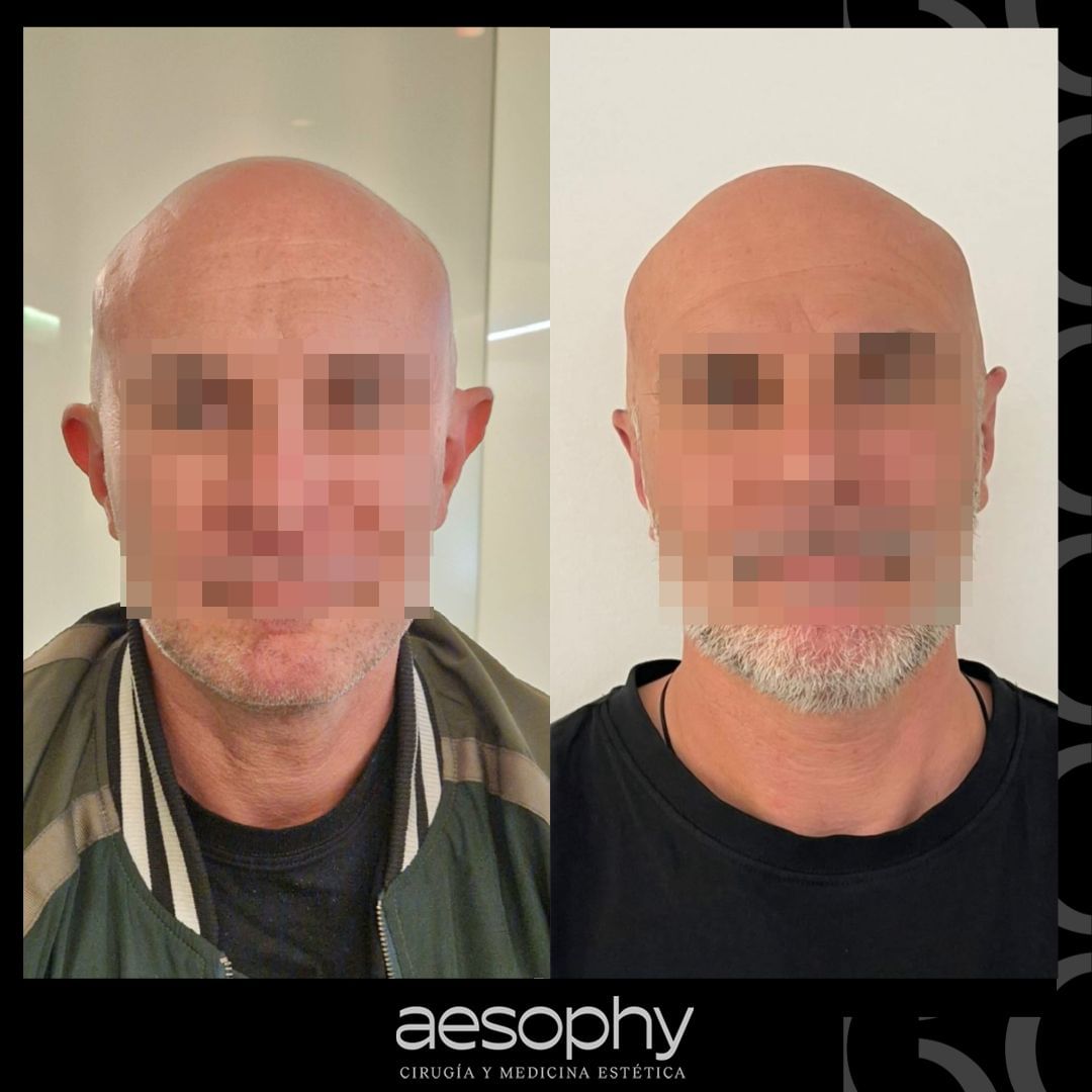 Otoplastia Málaga