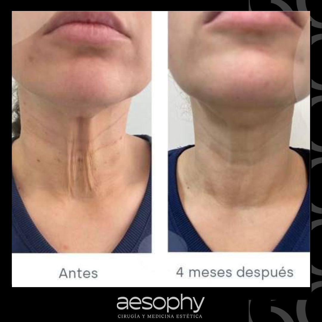 Antes y después rejuvenecimiento de cuello Málaga Clínica Aesophy Antes y después rejuvenecimiento de cuello Málaga Clínica Aesophy