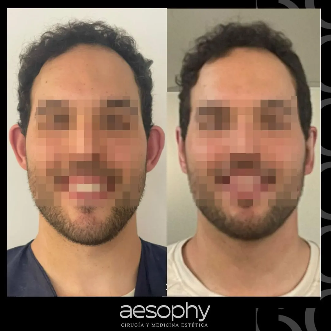 Otoplastia Málaga